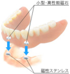 マグネット義歯